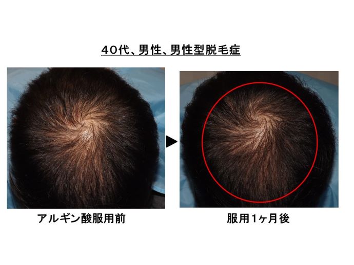 円形脱毛症　病院